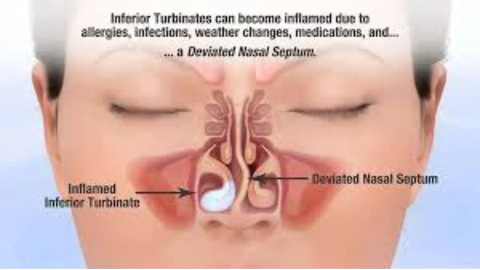 Why Do I Get Nose Blocks and Headaches in AC? Experienced ENT Doctor for Blocked Nose & Headaches in AC in Bangalore