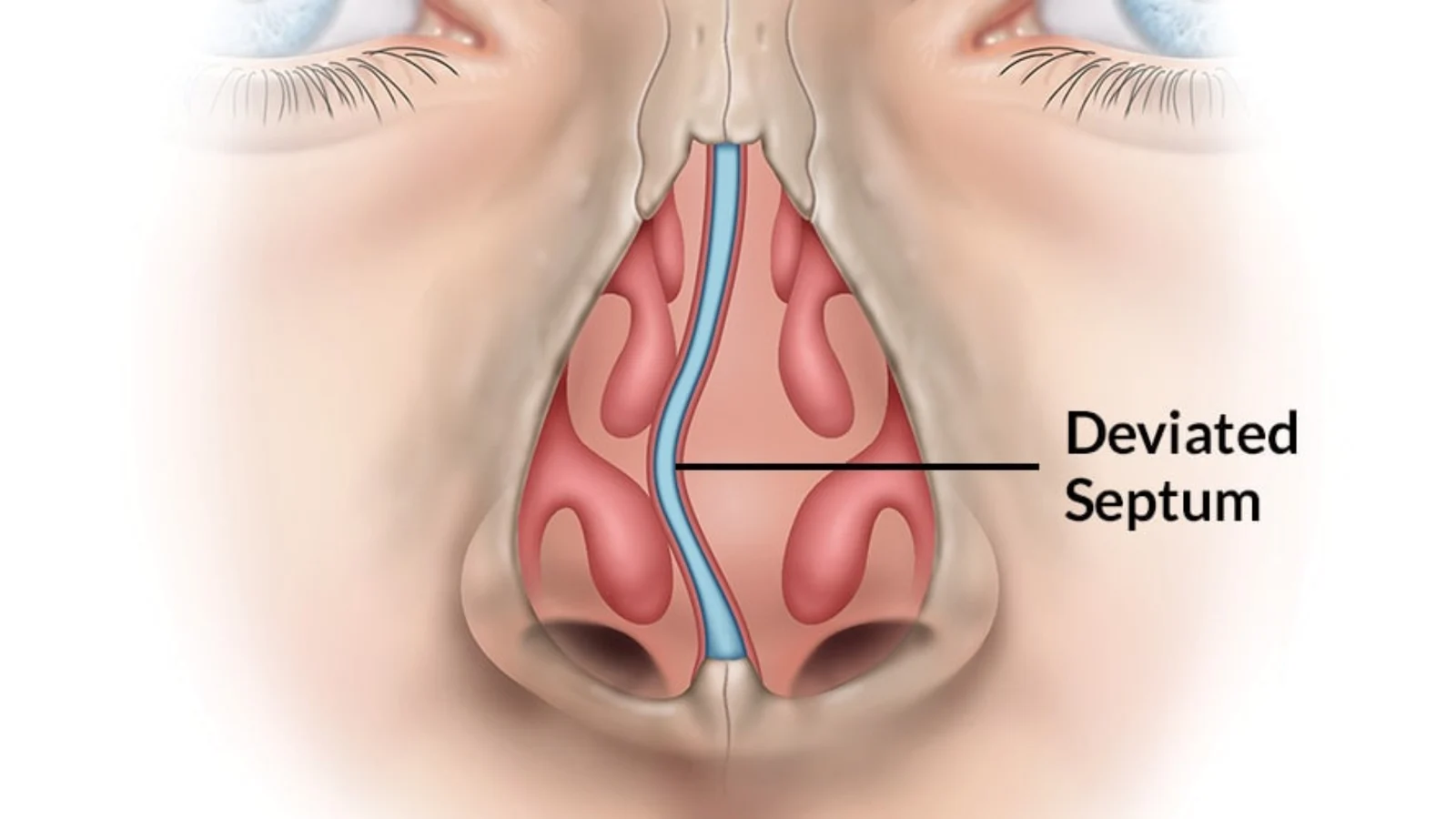 Is Your Nose the Real Reason Behind Your Snoring?