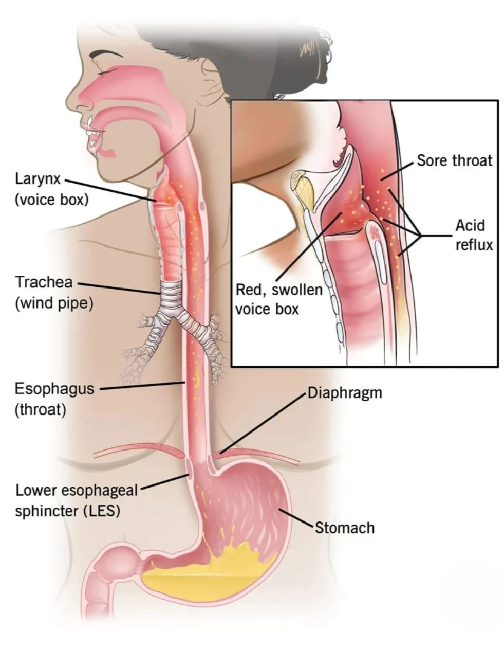 Chronic Cough? It Might Be Coming From Your Stomach — Not Your Lungs!